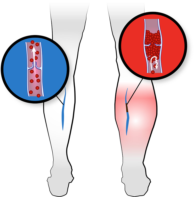 Thrombose veineuse profonde (TVP)