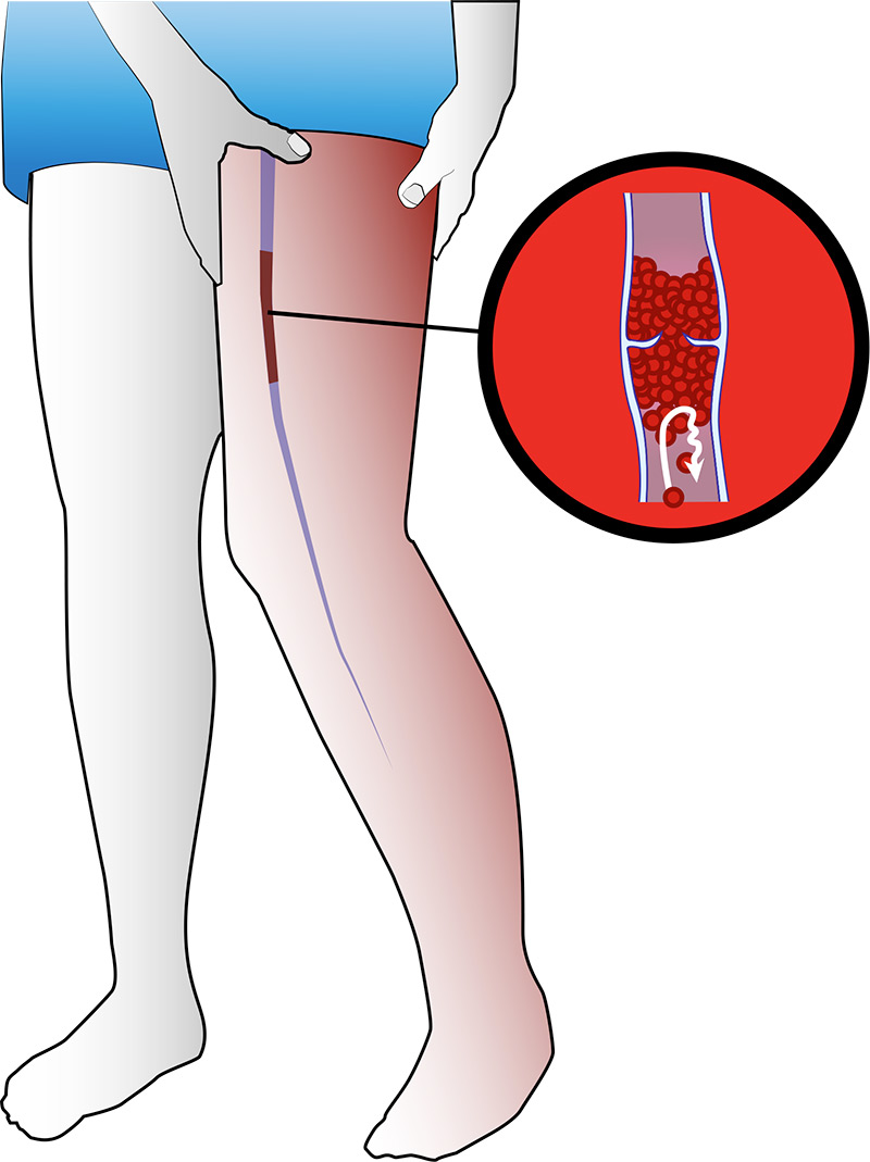 Signes de la thrombose veineuse profonde